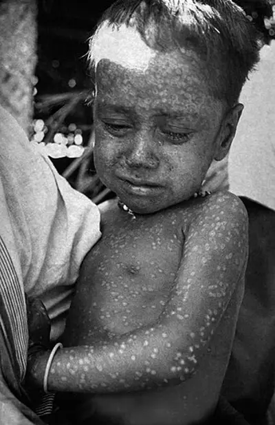 1975 three year old rahima banu from bangladesh is the last kno 10 16