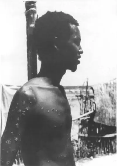 1977 ali maow maalin the last natural case of smallpox develops 10 26